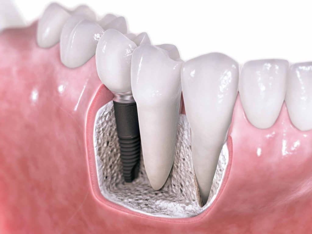 Implant dentaire : combien ça coûte ?